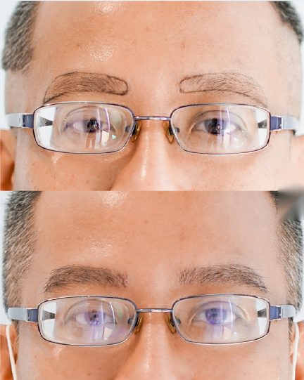 ผลลัพธ์ Eyebrow Transplant (EBT) ก่อนและหลัง 3