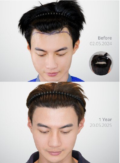 ผลลัพธ์ Partial Shave DHI ก่อนและหลัง 1