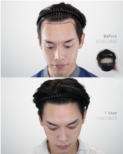 ผลลัพธ์ Partial Shave DHI ก่อนและหลัง 3