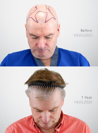 ผลลัพธ์ Shaven DHI Micrograft ก่อนและหลัง 1