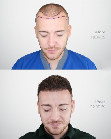 ผลลัพธ์ Shaven DHI Micrograft ก่อนและหลัง 3